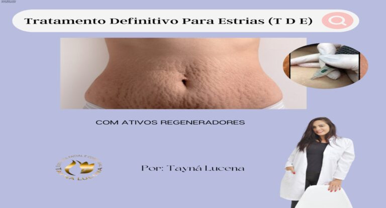 Tratamento Definitivo Para Estrias: Como Comprar e Onde Encontrar 6 Curso online Tratamento Definitivo Para Estrias mostrando técnica de regeneração dérmica