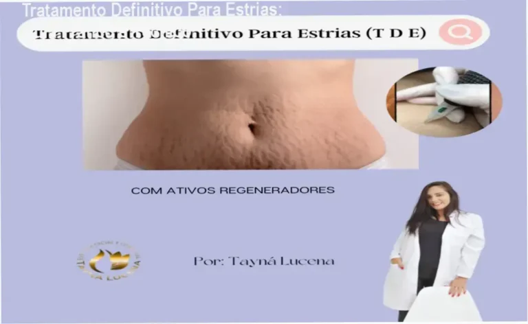 Imagem ilustrativa do método de tratamento definitivo para estrias com técnica de permeabilização dérmica