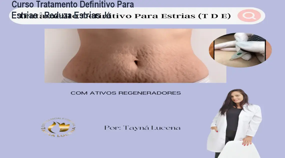 Curso Tratamento Definitivo Para Estrias – Reduza Estrias Já 1 Curso Tratamento Definitivo Para Estrias – Reduza Estrias Já