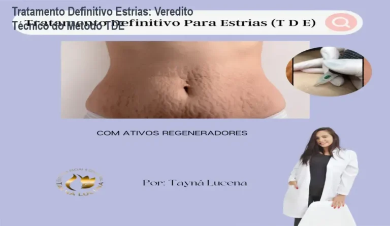Tratamento Definitivo Estrias: Veredito Técnico do Método TDE 9 Tratamento Definitivo Para Estrias Tayna de Lucena bastidores e funcionamento interno do método TDE