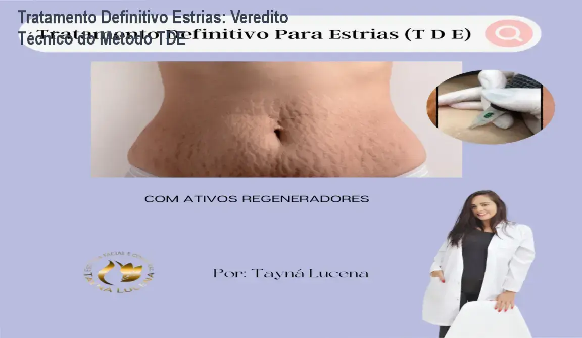 Tratamento Definitivo Estrias: Veredito Técnico do Método TDE 1 Tratamento Definitivo Para Estrias Tayna de Lucena bastidores e funcionamento interno do método TDE