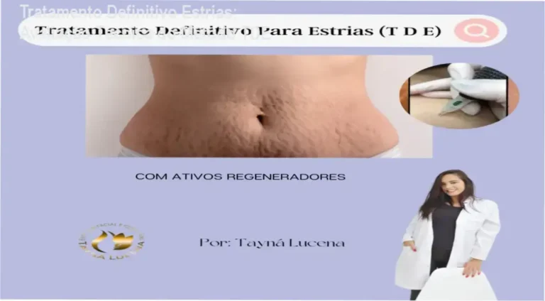 Tratamento Definitivo Para Estrias Tayna Lucena bastidores do método TDE regeneração dérmica